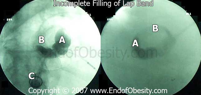 Lap Band Incomplete Filling