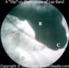 Lap Band Slip Prolapse