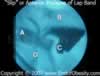 Lap Band Slip Prolapse on fluoroscopy